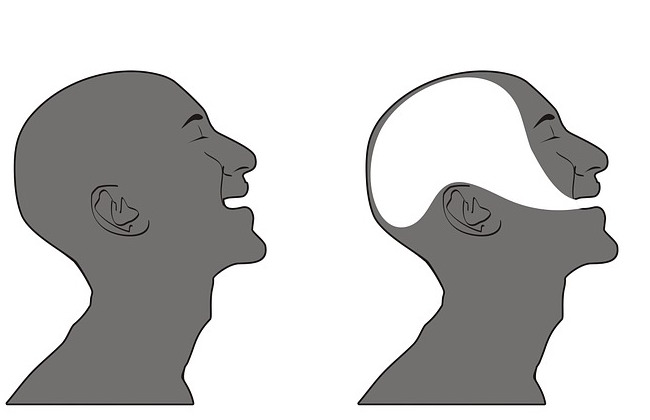 Dysarthria vs. Aphasia